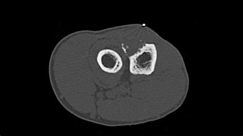 Chondromyxoid fibroma - wikidoc