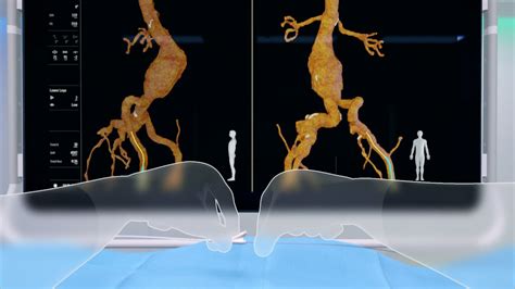 Reduction Of Radiation Exposure During Endovascular Treatment Of