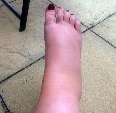 Swelling (oedema) remedies: photos - BabyCentre UK