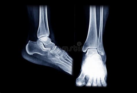 X-ray Image of Right Ankle Joint AP and Lateral View. Stock Photo ...