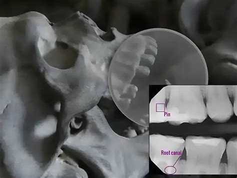 Forensic Dentistry Determination Of Sex From Tooth Dentin And Pulp