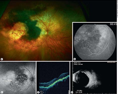 Figure 1 From Bilateral Diffuse Uveal Melanocytic Proliferation