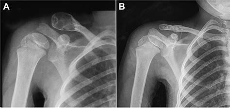 Aneurysmal Bone Cysts Of The Clavicle A Comparison Of Extended