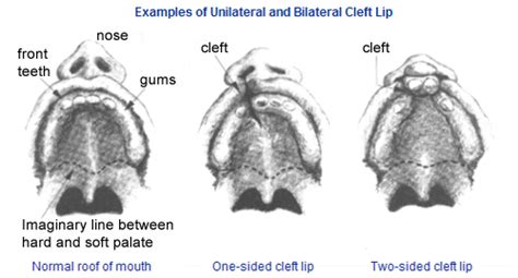 Bilateral Cleft Lip And Palate Genetics Sitelip Org