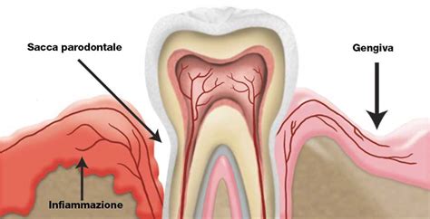 Tasche Gengivali E Infiammazione Delle Gengive Studio Dentistico