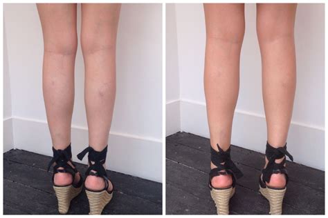 Makeup To Cover Veins On Legs Mugeek Vidalondon