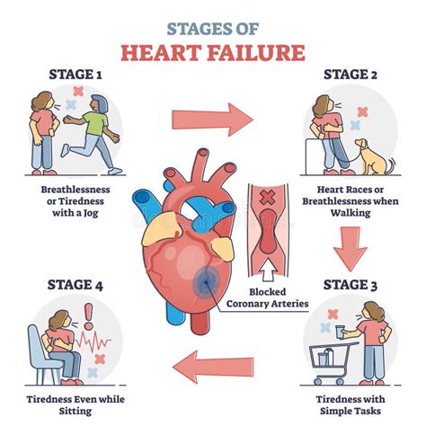 Stages of Heart Failure and Symptoms with Cardiology Stroke Outline ...