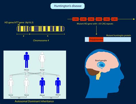 Brain Stimulation in Huntington's Disease Promising, According to Study