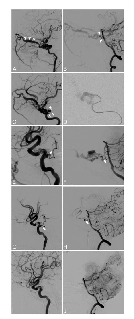 FIGURE E A Lateral View Of The Left ICA Angiography Showing A CCF