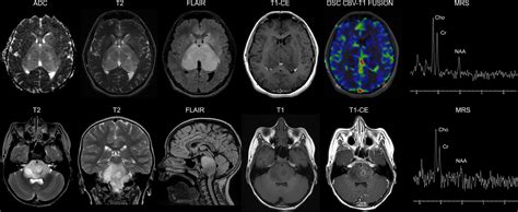 Frontiers Pediatric Diffuse Midline Glioma H3k27 Altered A Complex