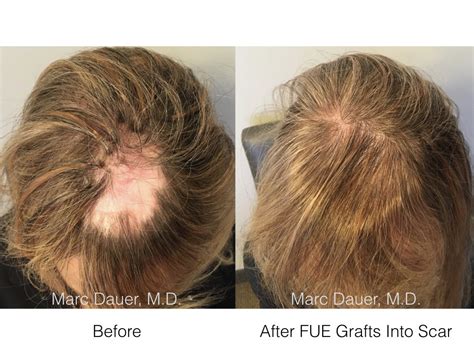 Hair Transplant Before And After Scar