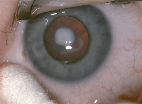 Nuclear Cataract Figure 6 Anterior Polar Cataract And Anterior