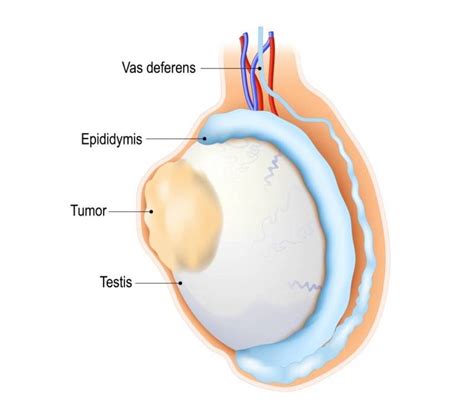 El Alcance Del Cáncer De Testículo Tu Canal De Salud