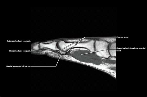 Mri Foot