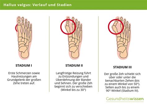 Hallux Valgus Ursachen Symptome Diagnose Behandlung