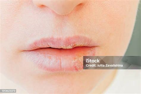 Close Up Bibir Gadis Yang Terkena Herpes Pengobatan Infeksi Herpes Dan