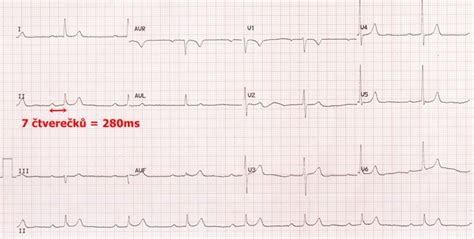 AV blok I stupně EKG Medicína nemoci studium na 1 LF UK