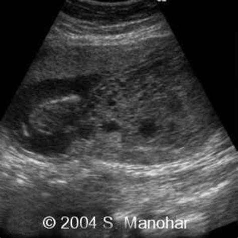 📃 Molar Pregnancy With Normal Fetus