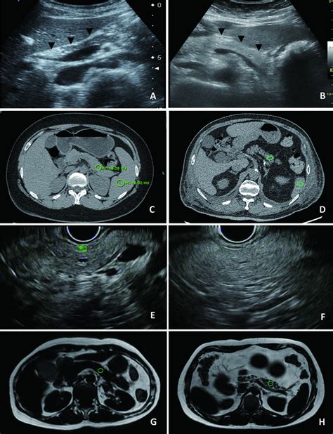 Imaging Of Fatty Pancreas A Transabdominal Ultrasonography Shows Download Scientific Diagram