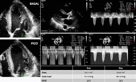 Ecocardiografia De Estresse Parte 9 Blog Ecope