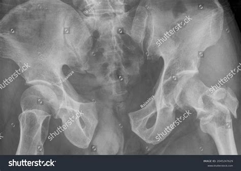 Pubic Diastasis Pelvic Fracture X Ray Shutterstock