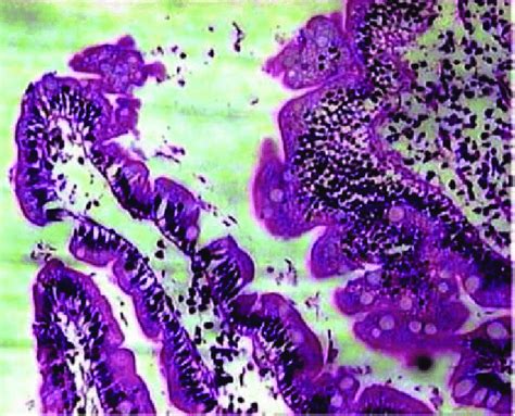 Biopsy Of Duodenal Mucosa Demonstrating Numerous Trophozoite Forms Of