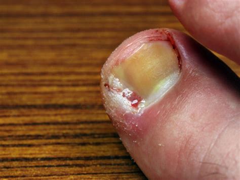 Infected Ingrown Toenail Abscess