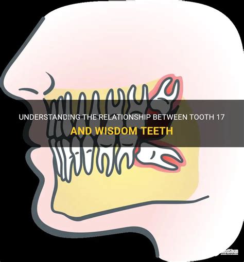 Understanding The Relationship Between Tooth 17 And Wisdom Teeth Medshun