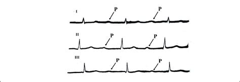 AV Block or Atrioventricular block » Digital Hybrid Education