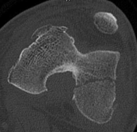 Hoffa Fragments In The Geriatric Distal Femur Fracture Myth Or Reality Brian W Hill Lisa K