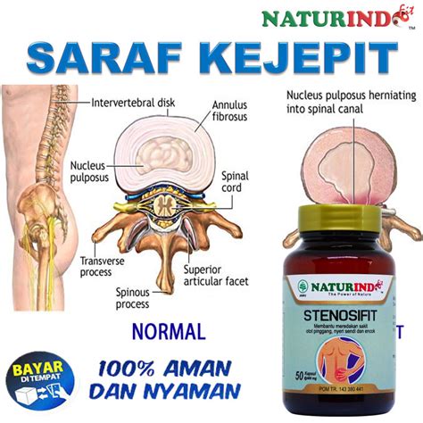 Jual Obat Saraf Kejepit Terjepit Sakit Pinggang Sakit Punggung Encok