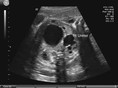 Prune-Belly Syndrome | Radiology Key