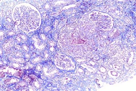 Renal Biopsy Light Microscopy On The Left Large Non Necrotizing Download Scientific Diagram