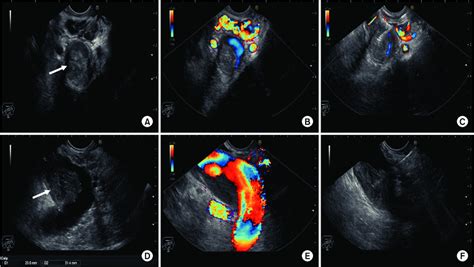 Endoscopic Ultrasound Fine Needle Aspiration Eus Fna Of A Portal Vein Download Scientific