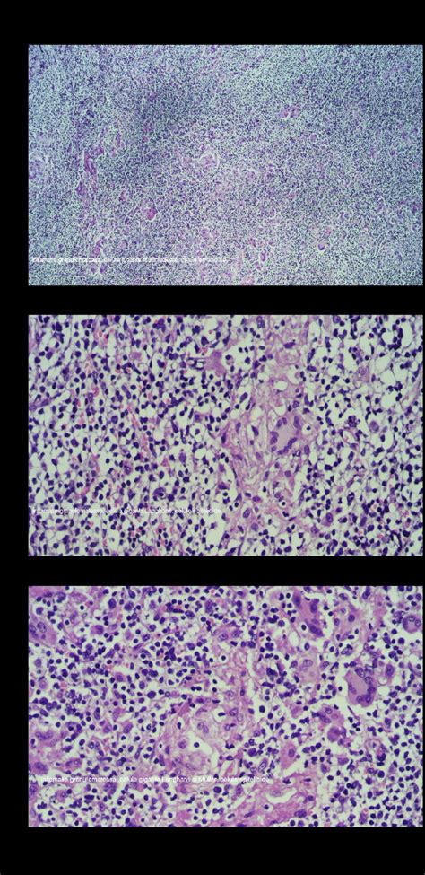 Granulomatous Inflammation Multinucleated Giant Cell Epithelioid