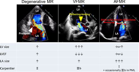 A New Disease Entity Atrial Functional Mitral Regurgitation Journal Of Cardiology