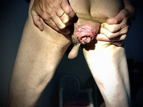 Dilatation And Anal Prolapse Pics Xhamster
