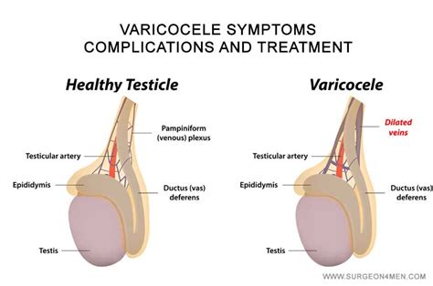 Esterilidad Masculina Diagnostico Varicocele