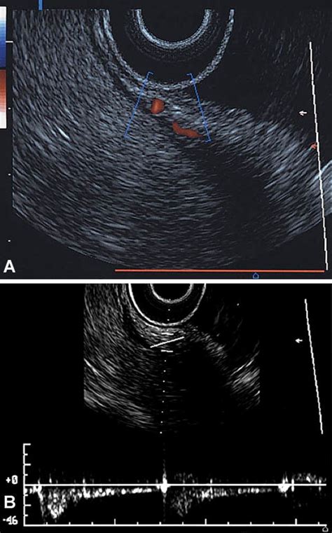 Doppler Eus Guided Treatment Of Gastric Dieulafoy S Lesion Gastrointestinal Endoscopy