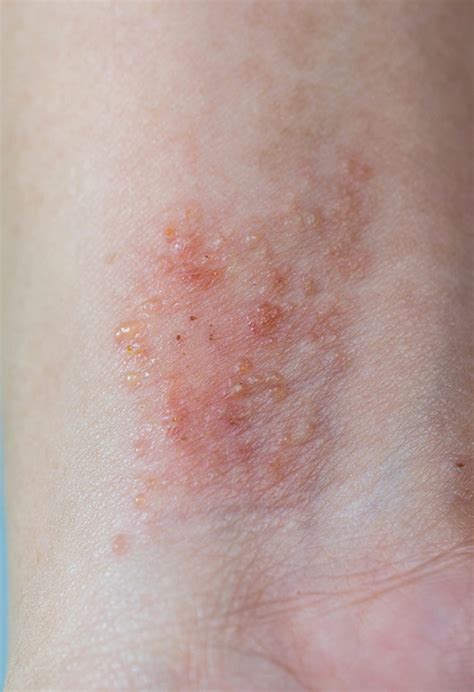 Atopijski Dermatitis Klinikaba