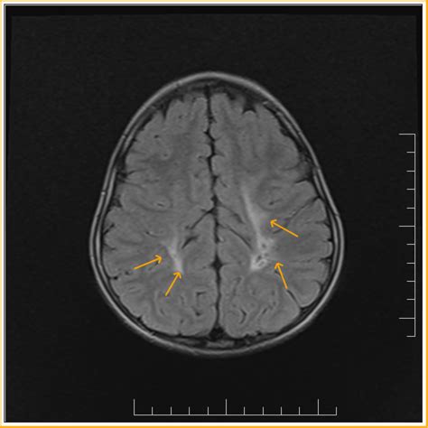 Periventricular leukomalacia: MRI - Sumer's Radiology Blog