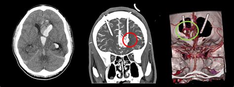 INTENSIVOS PEDIATRICOS MALFORMACIÓN ARTERIOVENOSA MAV CEREBRAL EN