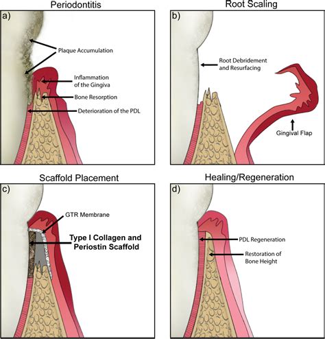 Figure 1 1 From Engineering Periodontal Tissue Regeneration With The