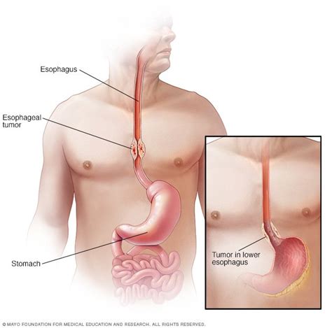 Esophageal Cancer Disease Reference Guide