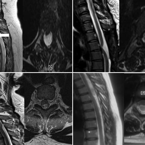 Mri Of Representative Cases Mri T2 Weighted Sagittal And Axial