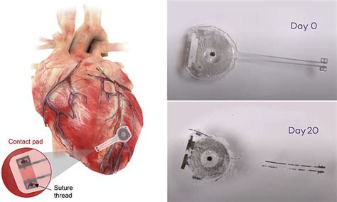 World S First Wireless Battery Free Fully Implantable Pacemaker