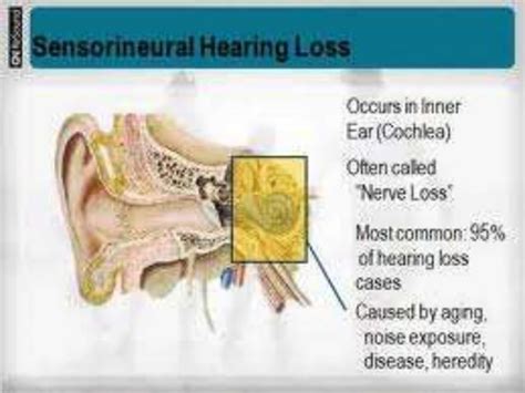 Hearing impairment | PPT