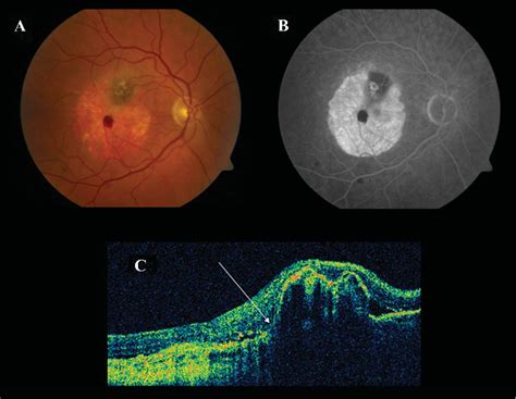 A New Grading System For Retinal Pigment Epithelial Tears Semantic