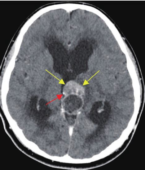 Preoperative Contrast Ct Scan Of The Brain Shows A Heterogeneously