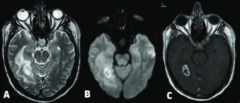 A T Weighted Magnetic Resonance Imaging Mri Axial View Showing A